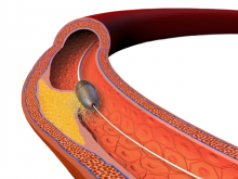 atherectomy rotational